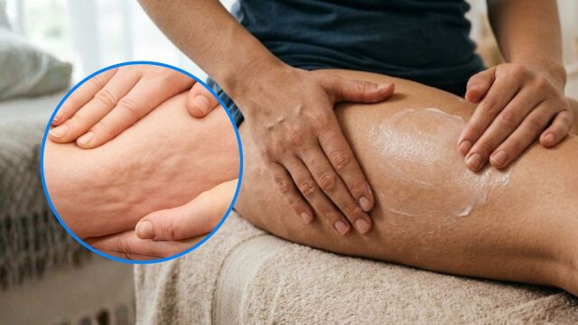Снимка: Работят ли антицелулитните кремове и продуктите за изгаряне на мазнини?