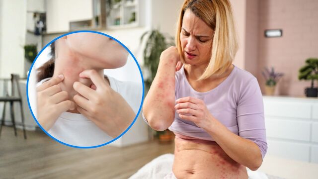 Снимка: Кожни алергии: Какво помага в домашни условия, според дерматолози