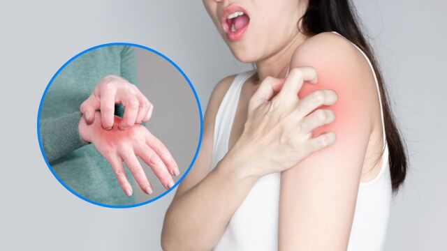 Снимка: Какво представлява крастата и как се предава?