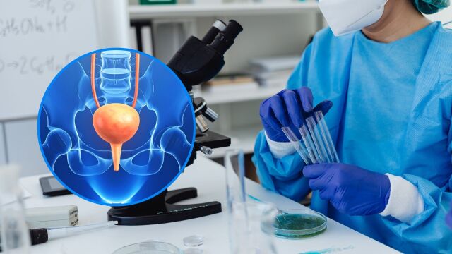 Снимка: Нов тест предсказва връщането на рак на пикочния мехур