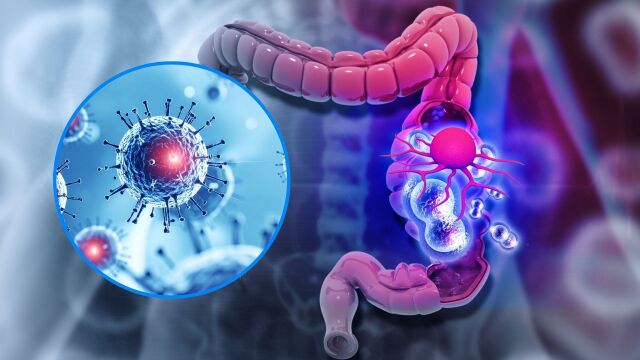 Снимка: Стадии на рак на дебелото черво: Какво означават?