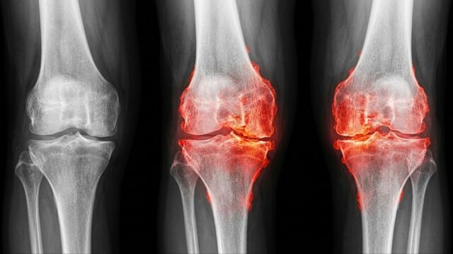 Снимка: Износените стави ще могат да се възстановяват, твърдят учени