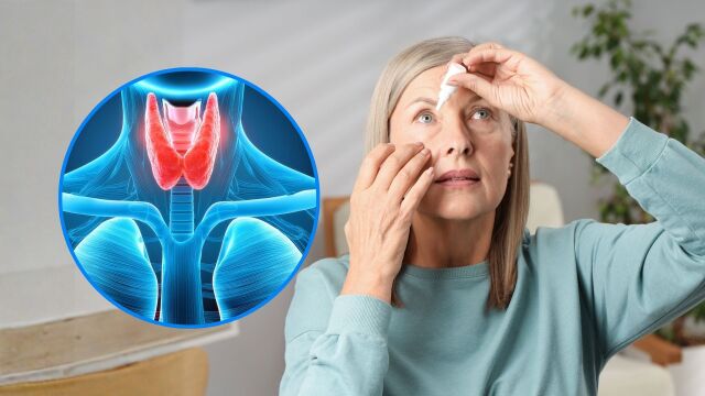 Снимка: Тиреоидна очна болест: Когато имунната система атакува зрението