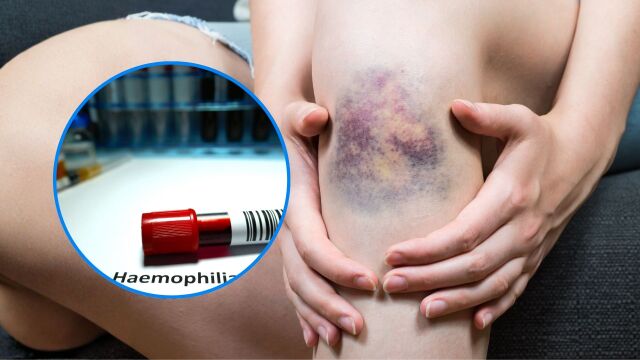 Снимка: 5 ключови симптома на хемофилия, за които да внимавате