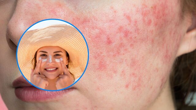 Снимка: 5 начина как да се справим с розацеята през пролетта