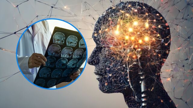 Снимка: Симптоми на глиобластом: Как да разпознаем ранните признаци навреме?