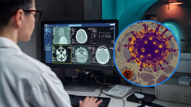 Снимка: Постковид синдромът променя мозъка и води до когнитивен спад