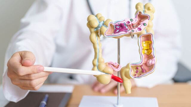 Снимка: Възпаление на дебелото черво (колит): Какви са симптомите и как се лекува