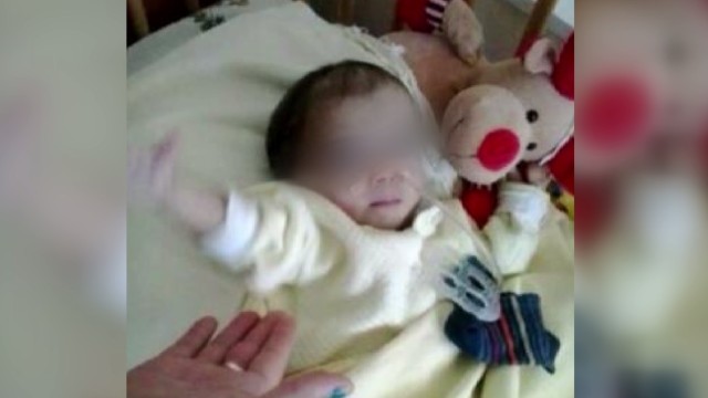Снимка: Разделянето на сиамските близнаци от Сливен – анатомично невъзможно