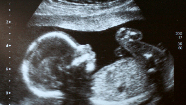 Снимка: Жена с трансплантирана от трупен донор матка роди здраво бебе