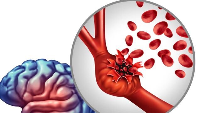 Снимка: Мозъчна аневризма: Ранни признаци, които не бива да игнорирате