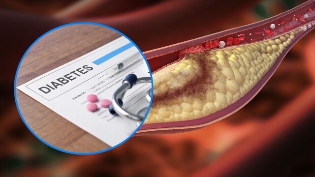 Снимка: Ниският лош холестерол може да увеличи риска от диабет тип 2