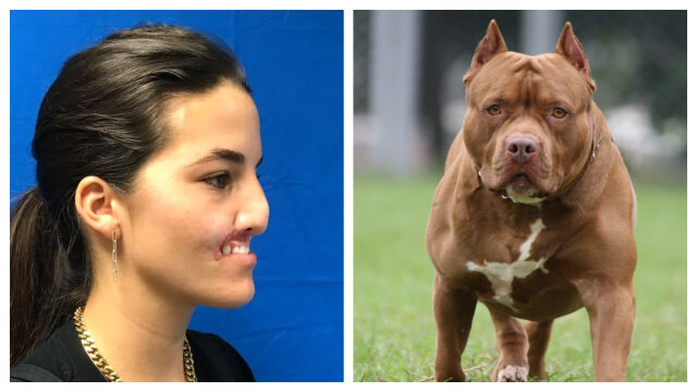 Снимка: Бруклин Хури, която губи лицето си след атака от питбул - история за смелост и ново начало