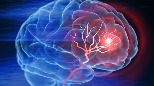 Снимка: 6 основни причини за инсулт при млади хора, според кардиолог