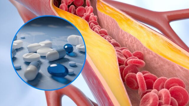 Снимка: Прочистване на кръвоносните съдове без лекарства: Възможно ли е