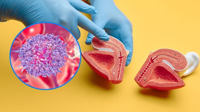 Снимка: Рак на пикочния мехур: Детски вирус може да провокира заболяването