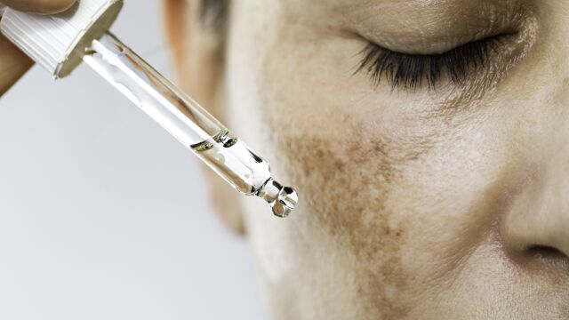 Снимка: Не подценявайте тъмните петна по кожата: Може да сигнализират за диабет