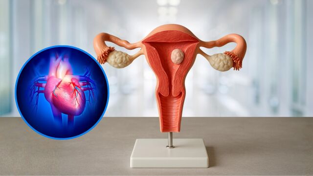 Снимка: Миома на матката може да повиши риска от сърдечно-съдови заболявания