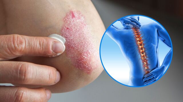 Снимка: Псориатичният артрит може да увреди стави, сърце и зрение