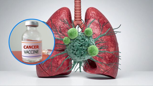 Снимка: Ваксина срещу рак на белия дроб: Започва първото клинично изпитване в света