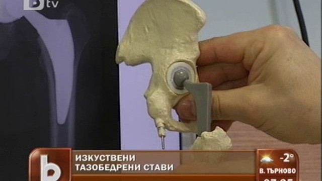 Снимка: Бъдете здрави: Модерна техника за заместване на двете тазобедрени стави
