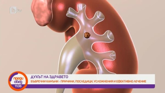 Снимка: Духът на здравето: Как да предотвратим образуването на камъни в бъбреците?