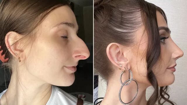 Снимка: Тотална промяна! Жена харчи 11 хил. долара за операция на носа (СНИМКИ)