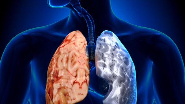 Снимка: Каква е причината за рака на белия дроб при непушачи?