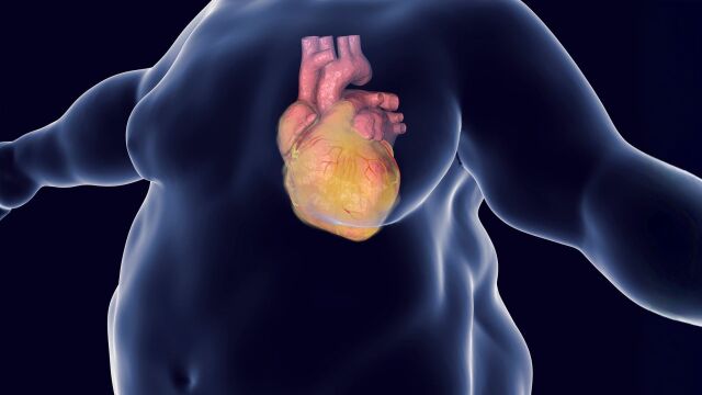 Снимка: Мазнини около сърцето увеличават риска от инфаркт и инсулт