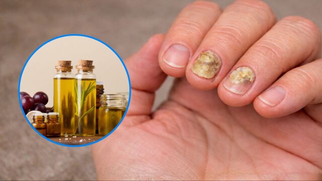 Снимка: 14 натурални средства срещу гъбички по ноктите
