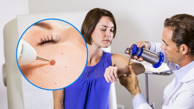 Снимка: Криотерапия: Премахване на кокоши трън, брадавици, дори и ракови клетки