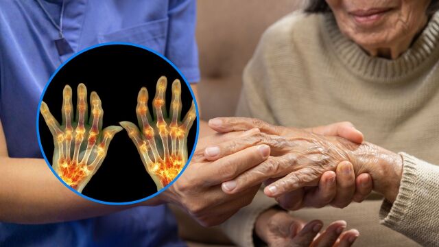Снимка: Видове ревматоиден артрит и кой е по-труден за лечение
