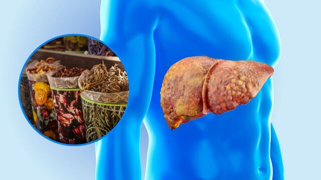 Снимка: Лечение на омазнен черен дроб: 8 натурални метода за справяне с болестта