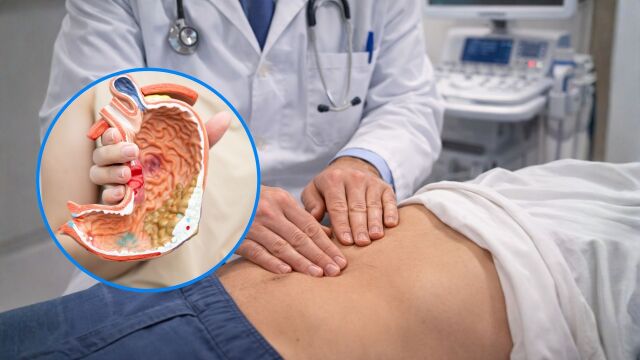 Снимка: Как се лекува рак на хранопровода и стомаха?