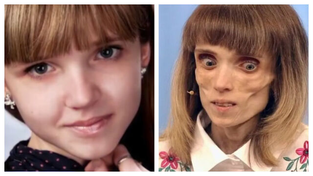 Снимка: Историята на Кристина, която стига до 17 килограма в стремеж към „съвършенство“