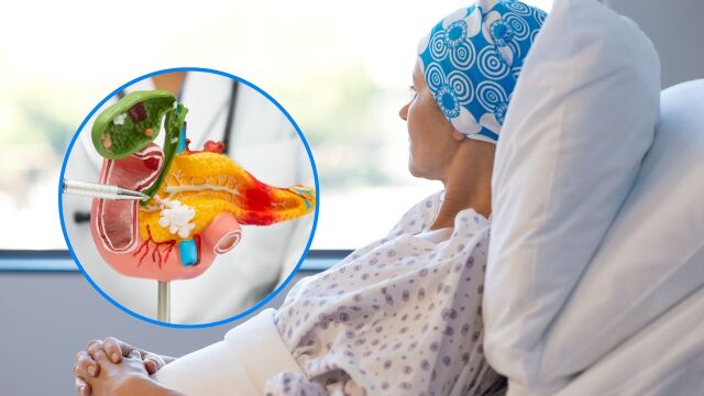 Снимка: Стадии на рак на панкреаса: Симптоми и видове лечение