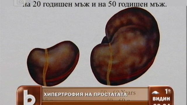 Снимка: Хипертрофия на простатата