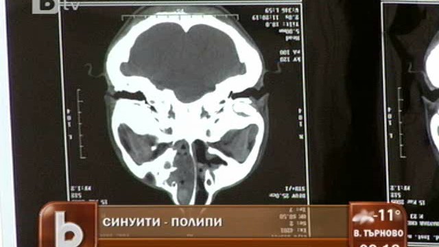 Снимка: Силното главоболие може да е признак за синузит 