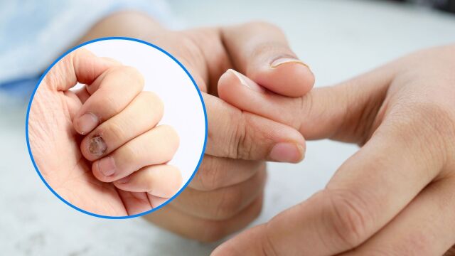 Снимка: Псориазис на ноктите: Как да го разпознаем и лекуваме