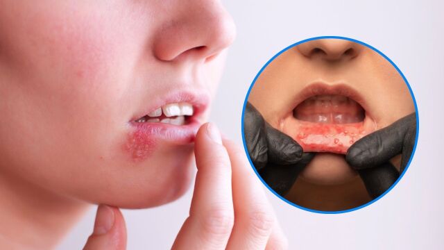 Снимка: Заразен ли е херпес симплекс: Какви начини за лечение има