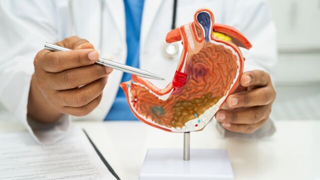 Снимка: 5 симптома на рак на стомаха, които се бъркат с лошо храносмилане