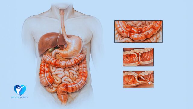 Снимка: Нова диета при болест на Крон: 5 дни месечно гладуване облекчават симптомите