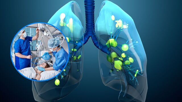 Снимка: Кога вирусната инфекция от грип може да прерасне в пневмония