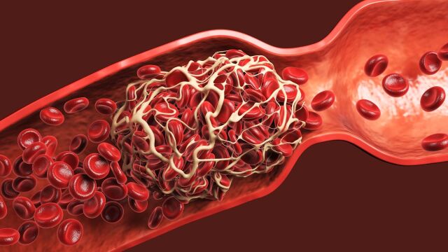 Снимка: 10 признака на тромбоза, които не бива да пренебрегвате