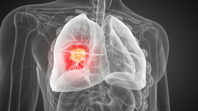 Снимка: Прогресия при рак на белия дроб: Растежът на туморите определя лечението