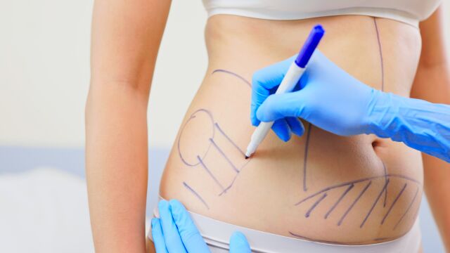 Снимка: Видове операции за отслабване: Как да изберете най-добрата