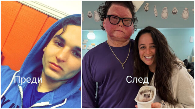 Снимка: 80% изгорял, 100% силен! Първа трансплантация на лице и ръце и открива любовта (СНИМКИ) 