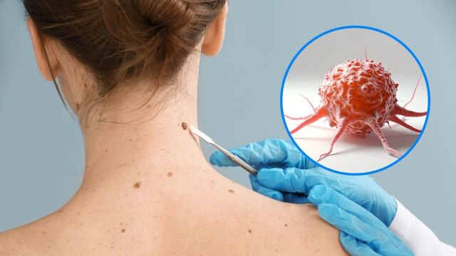 Снимка: Хирургия на Моос: Най-ефективното лечение на рак на кожата