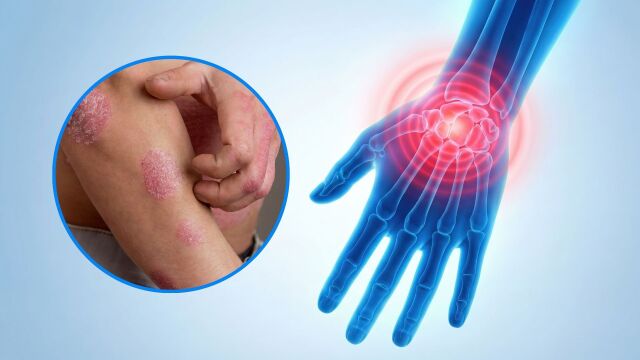 Снимка: Учени установяват как псориазисът се превръща в псориатичен артрит