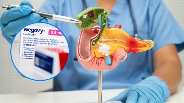 Снимка: Камъни в жлъчката след инжекции за отслабване?